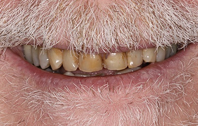 Closeup of unnatural looking upper denture