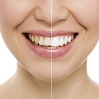 Teeth split to show before and after whitening tooth coloring