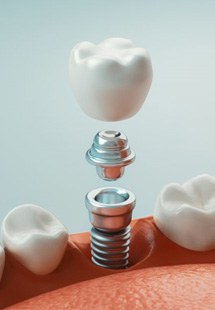 a 3D illustration of a dental implantr