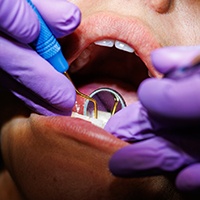 Bellingham dental hygienist performing deep cleaning procedure