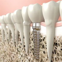 Dental implant illustration